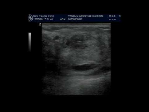Vacuum Resection of Breast on Ultrasound 1